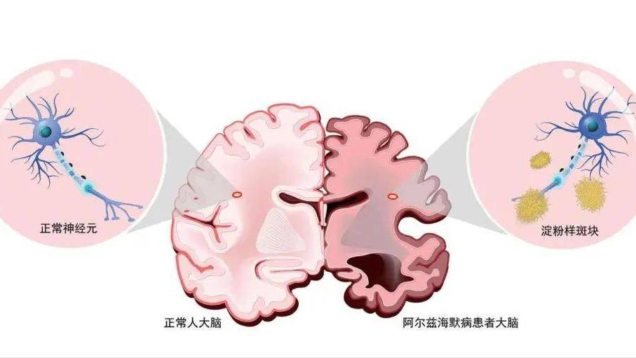 老年痴呆最新治疗进展与策略探索