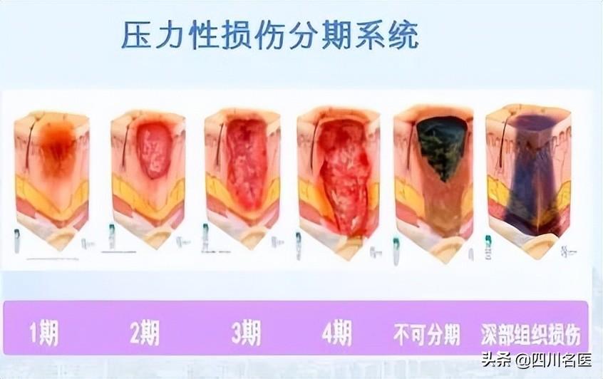 压疮分期与护理方法解析