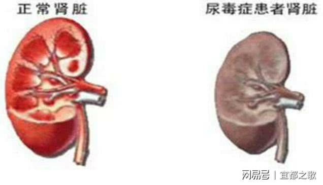 尿毒症最新研究及治疗进展综述