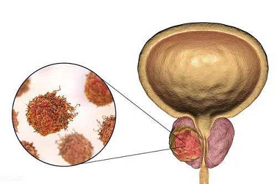 膀胱肿瘤最新治疗方法的探索与应用